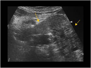 Tumor thrombus in the left renal vein anterior of the aorta transverse