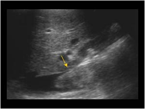 Tumor thrombus in the vena cava longitudinal