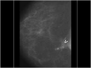 Mammography 2003 showing scar