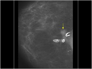 Mammography 2005 showing mass next to the scar