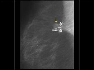 Mammography 2005 showing mass next to the scar