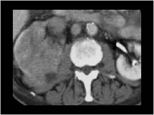 Renal cell carcinoma with tumor thrombus in the renal vein