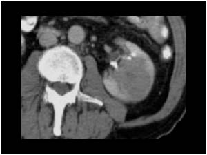 Non Hodgkin lymphoma with a renal mass