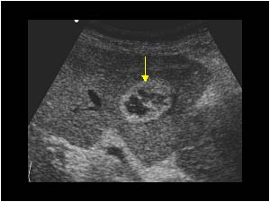 Pericholecystitis and small abscess