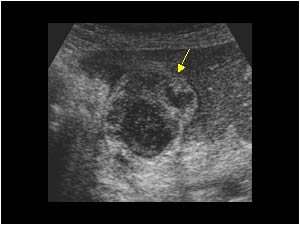 Pericholecystitis and small abscess