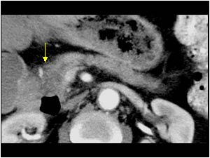 Pancreatic head carcinoma in relation to the duodenum