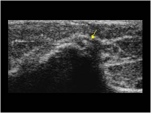 Calcifications in the distal insertion of the ulnar collateral ligament transverse