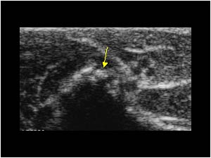 Calcifications in the distal insertion of the ulnar collateral ligament transverse
