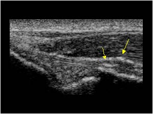Thickening of the distal insertion of the ulnar collateral ligament longitudinal