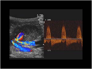 Typical doppler spectrum in the neck of the aneurysm