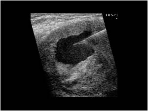 Ultrasound guided puncture