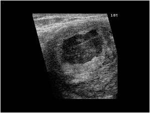 Ultrasound guided thrombin injection
