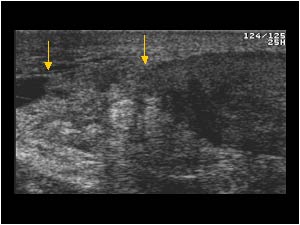 Full thickness achilles tendon rupture with tendon ends (arrows) longitudinal
