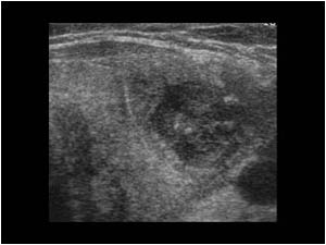 Thyroiditis with abscess in the left thyroid lobe transverse