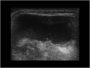 Cystic mass with a thick irregular wall