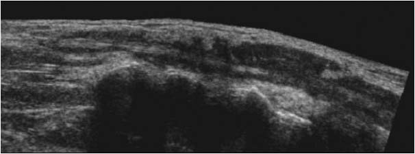Tenosynovitis of the extensor digiti minimi tendon longitudinal