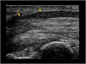 Compression and thickening of the median nerve longitudinal