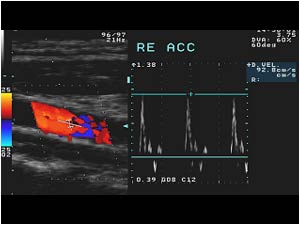 Abnormal high resistance doppler signal in the right common carotid artery