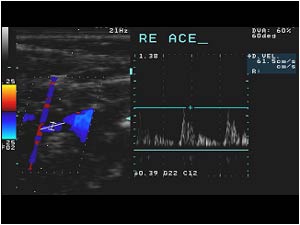 Normal doppler signal in the right exrternal carotid artery