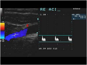 Abnormal high resistance doppler signal in the right internal carotid artery
