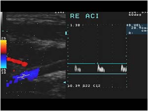Abnormal high resistance doppler signal in the right internal carotid artery