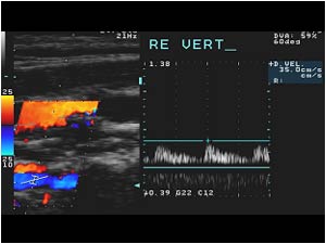Normal doppler signal in the right vertebrel artery