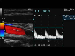 Normal doppler signal in the left common carotid artery