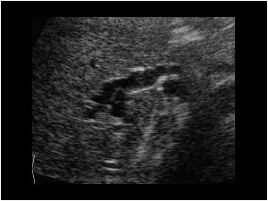 Segmental dilatation of the intrahepatic bile ducts in the right liver lobe