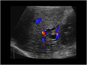 Segmental dilatation of the intrahepatic bile ducts in the right liver lobe