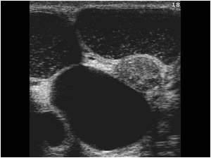 Atypical benign cysts