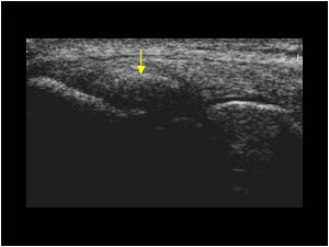Extensor tendon insertion calcifications longitudinal
