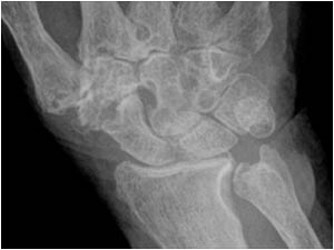 Arthritis wrist and carpus