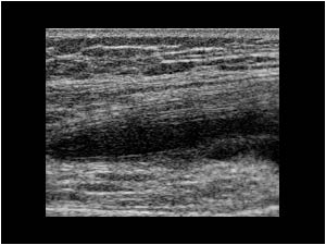 Effusion and synovial thickening in the suprapatellar recess