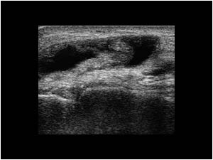 Thickened tendon and synovial fluid transverse