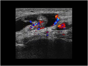 Hypervascularized thickened tendon and synovium transverse