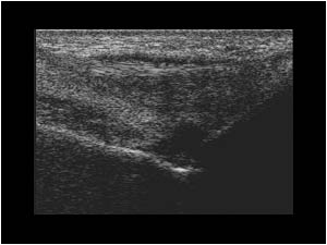 Arthritis and tenosynovitis of the extensor tendon longitudinal