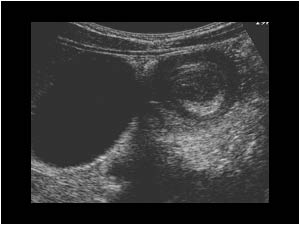 Intussusception with a target like mass next to the gallbladder