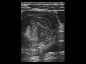 Intussusception with a target like mass transverse