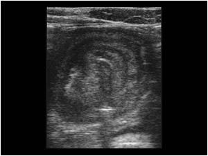 Intussusception with a target like mass transverse