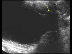 Dilatated posterior urethra longitudinal