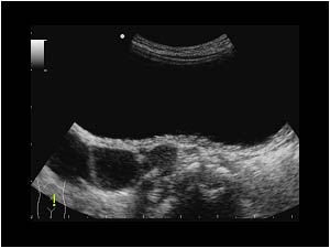 Distal ureteric dilatation transverse