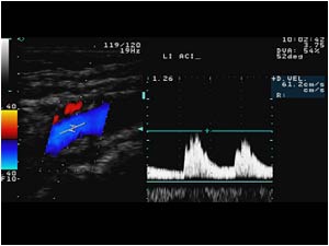 Normal doppler signal in the left internal carotid artery