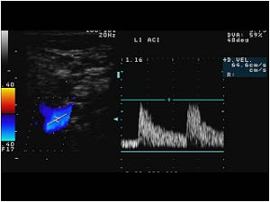 Normal doppler signal in the left internal carotid artery