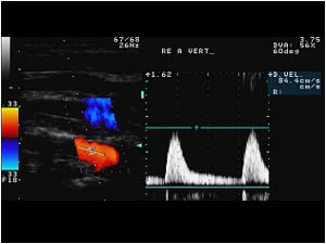 Normal doppler signal in the right vertebral artery