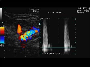 High grade stenosis with high systolic velocity in the left subclavian artery