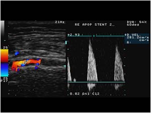Stenosis with high systolic velocity in the popliteal artery