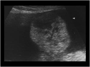 Ovarian hemangioma