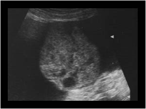 Ovarian hemangioma
