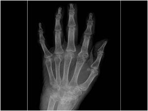 X ray of the hands of the same patient