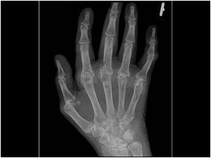 X ray of the hands of the same patient